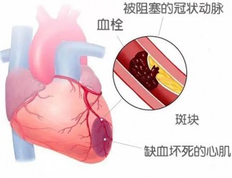 血栓的形成原因及后果，如何预防血栓导致的疾病